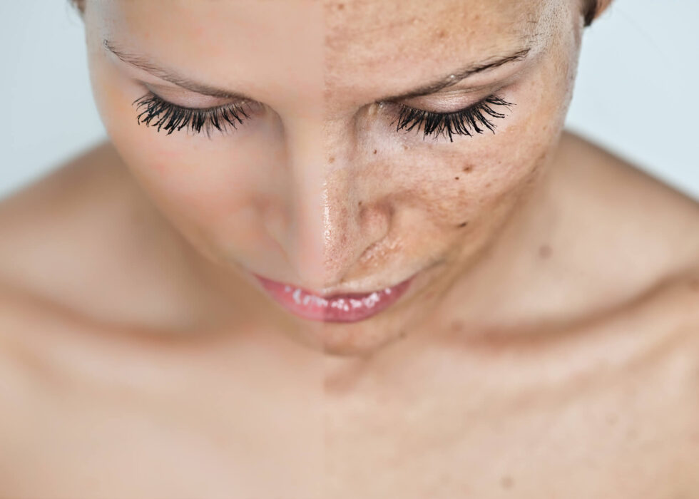 Depigmentation Pacifica
