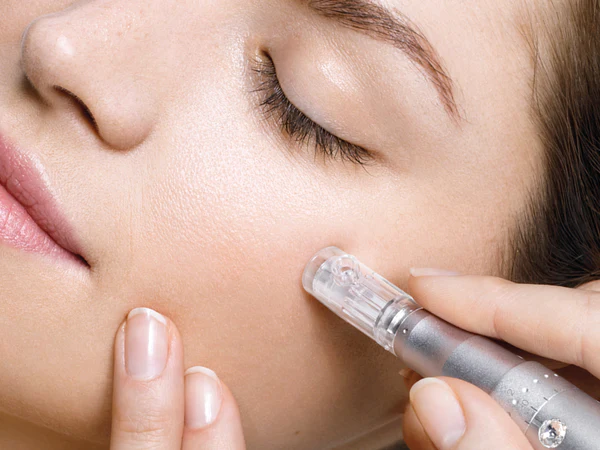Microneedling in Pacifica