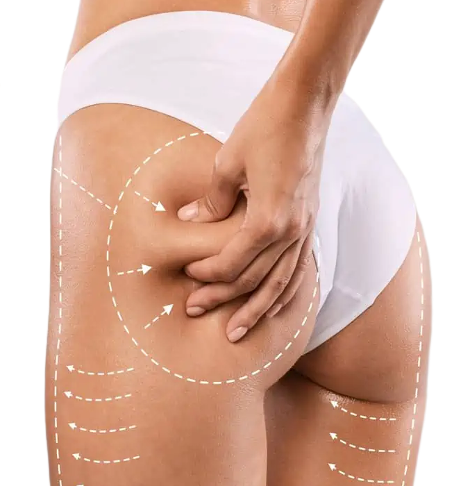 Radiesse Buttock Augmentation